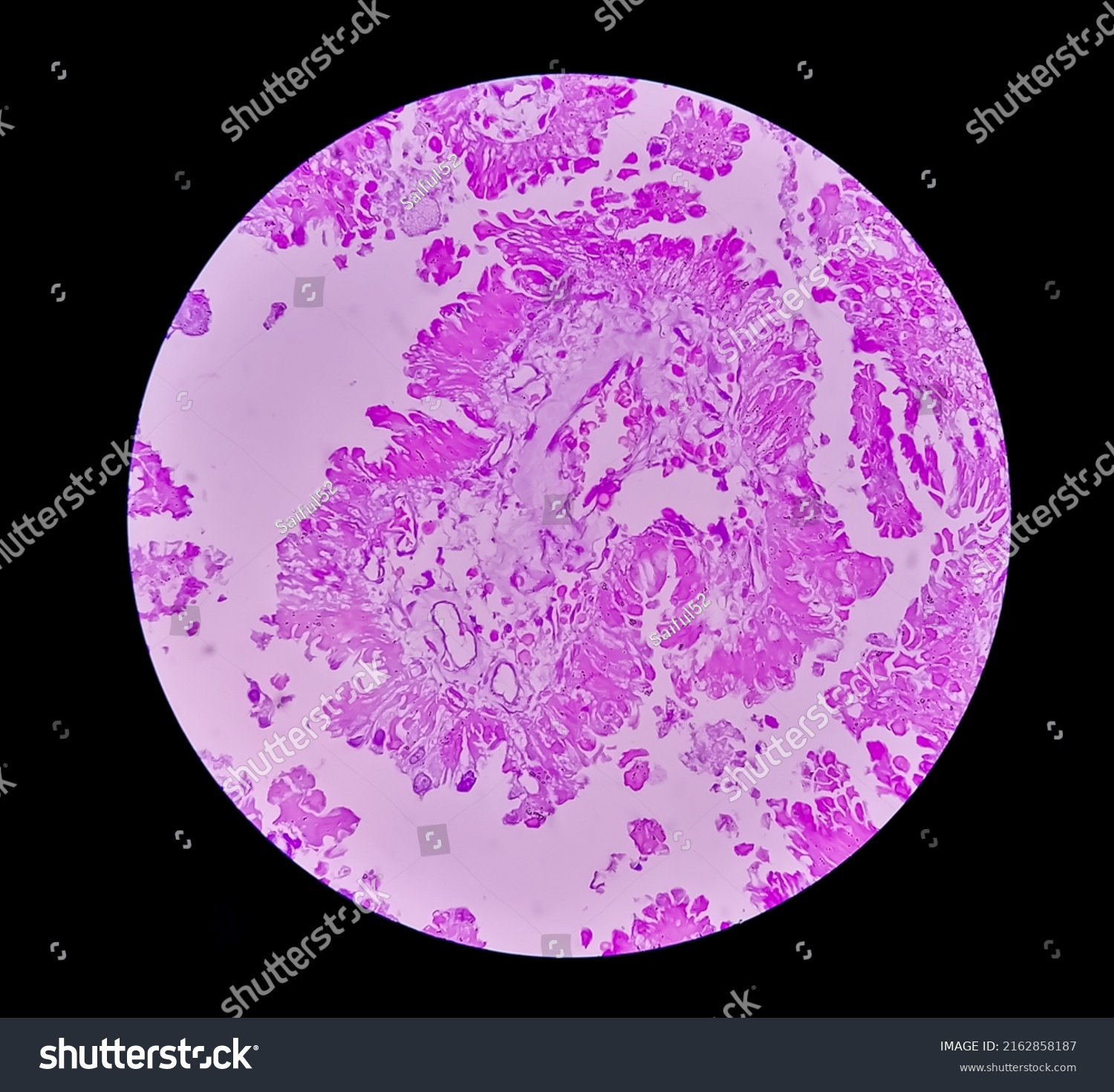 Histology Metastatic Papillary Adenocarcinoma Stock Photo 2162858187 ...