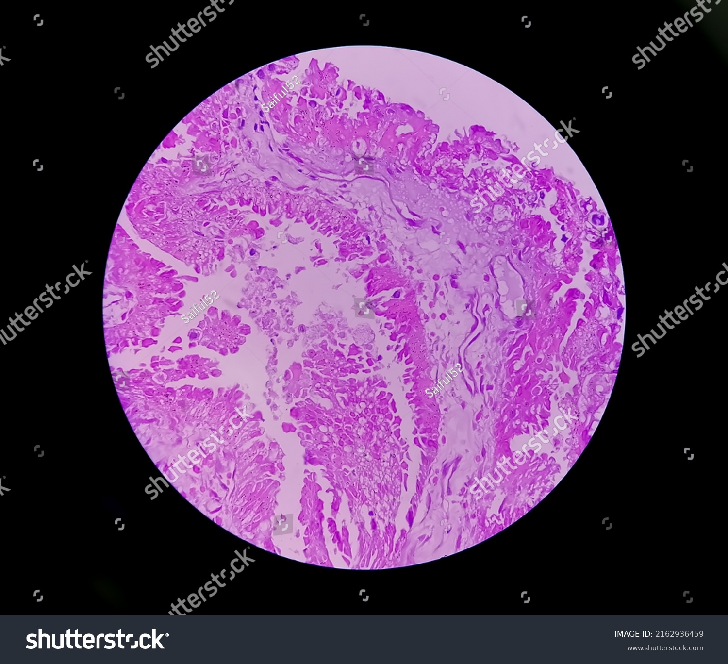 Histology Metastatic Papillary Adenocarcinoma Stock Photo 2162936459 ...