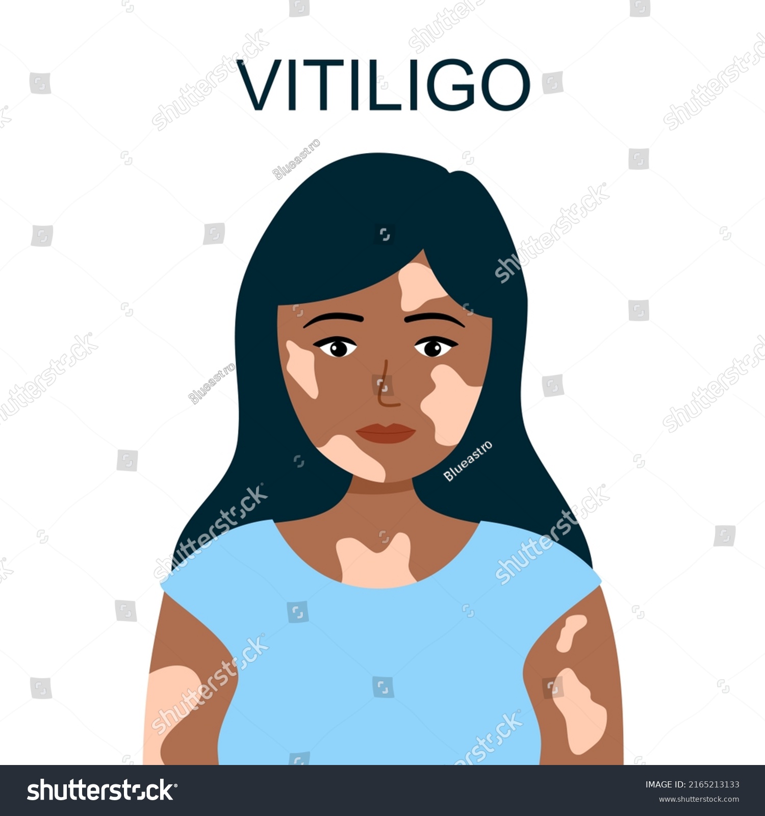 Vitiligo Skin Disease Concept Vector Illustration Stock Vector Royalty Vitiligo Skin Disease Concept Vector Illustration Stock Vector Royalty