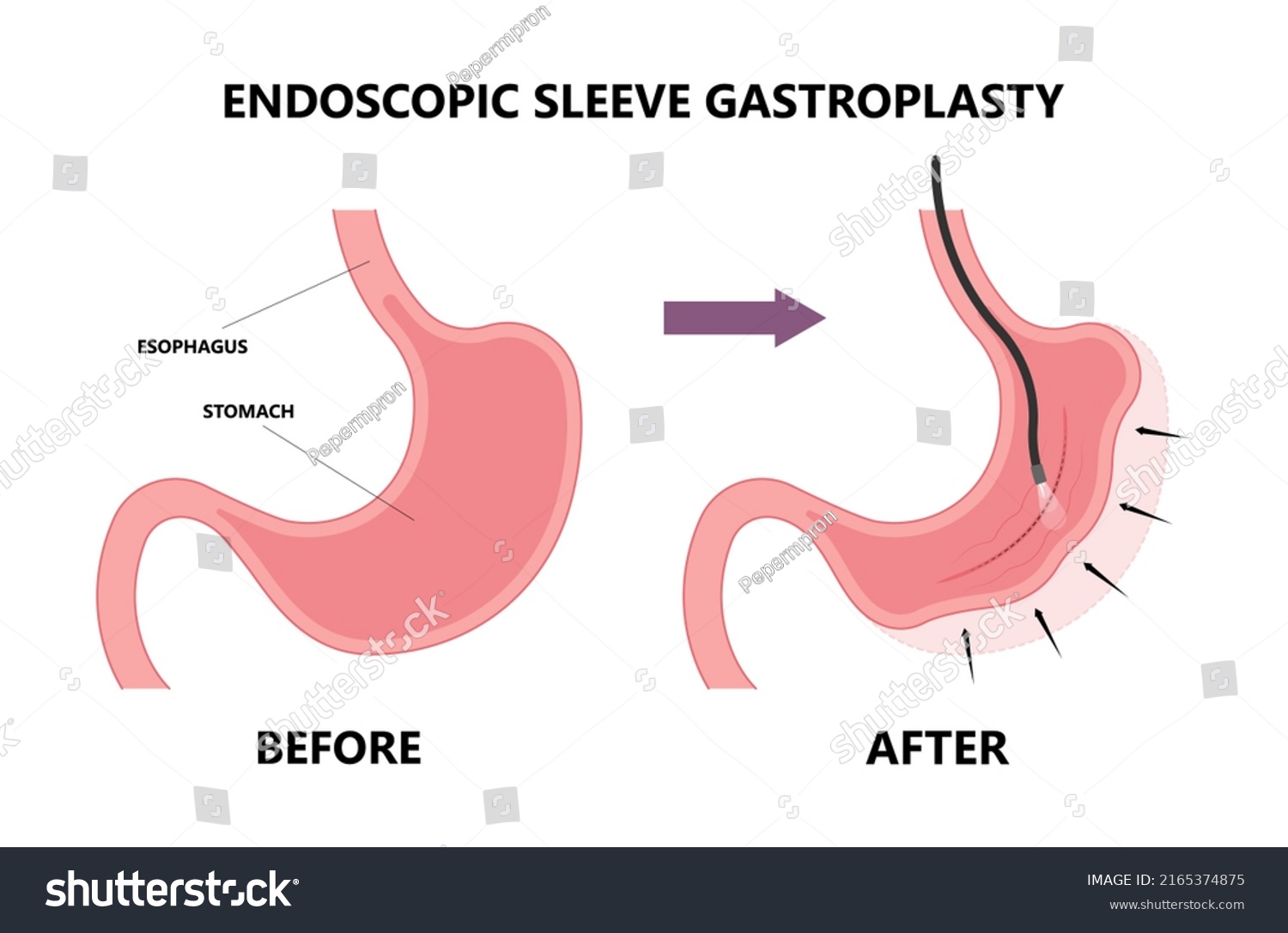 Gastric Bypass Surgery Band Roux En Stock Vector (royalty Free 