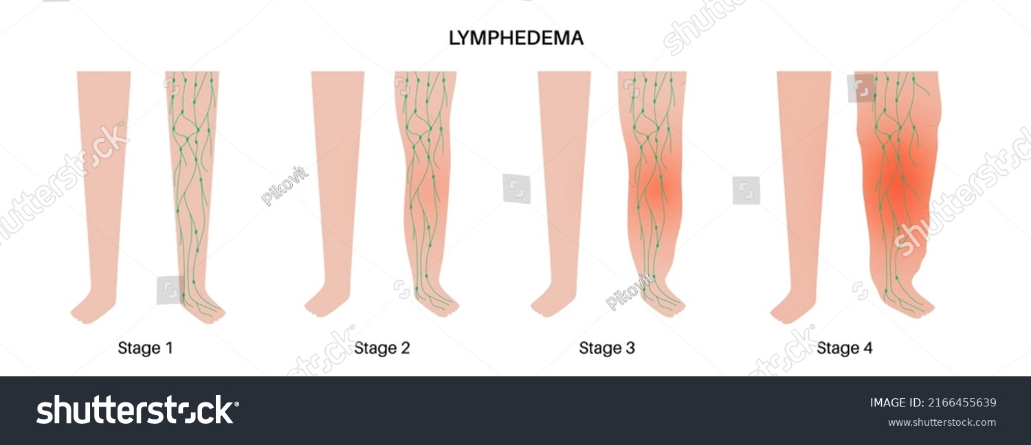 Concept de maladie du lymphoedème. Étapes : image vectorielle de stock ...