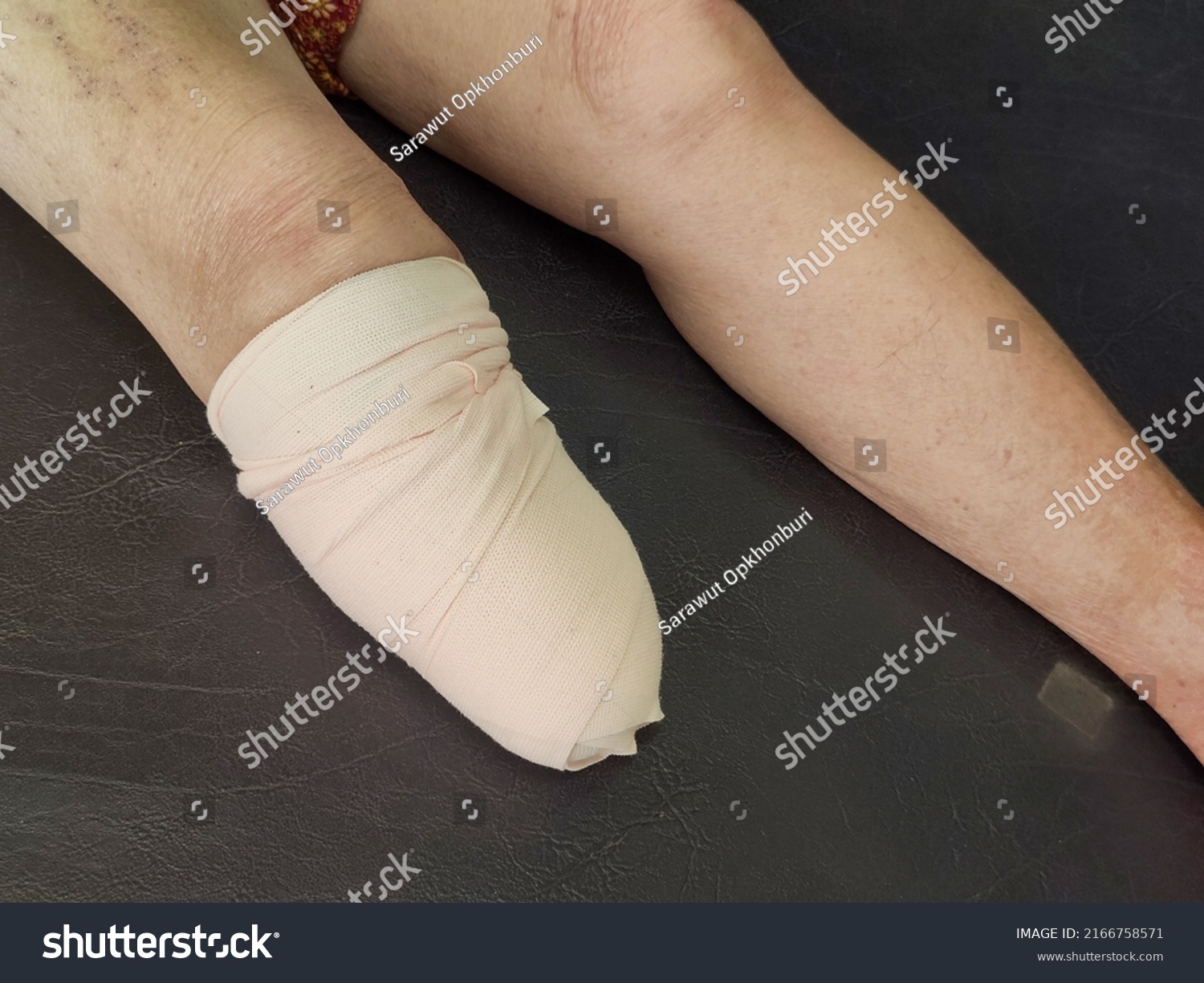 Below Knee Amputation Bandaging Bk Prosthesis Stock Photo 2166758571 ...