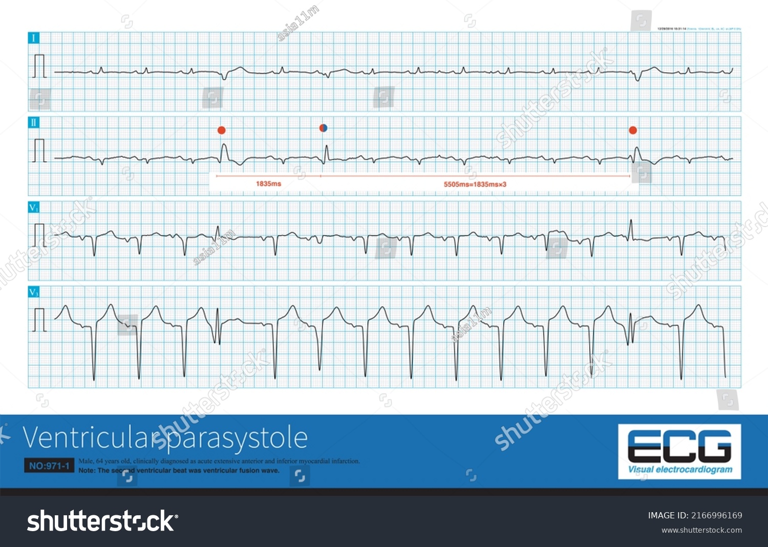 One Patient Acute Myocardial Infarction Had Stock Illustration ...