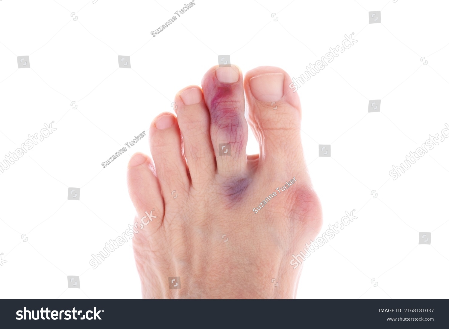 bruised-injured-middle-toe-big-toe-stock-photo-2168181037-shutterstock