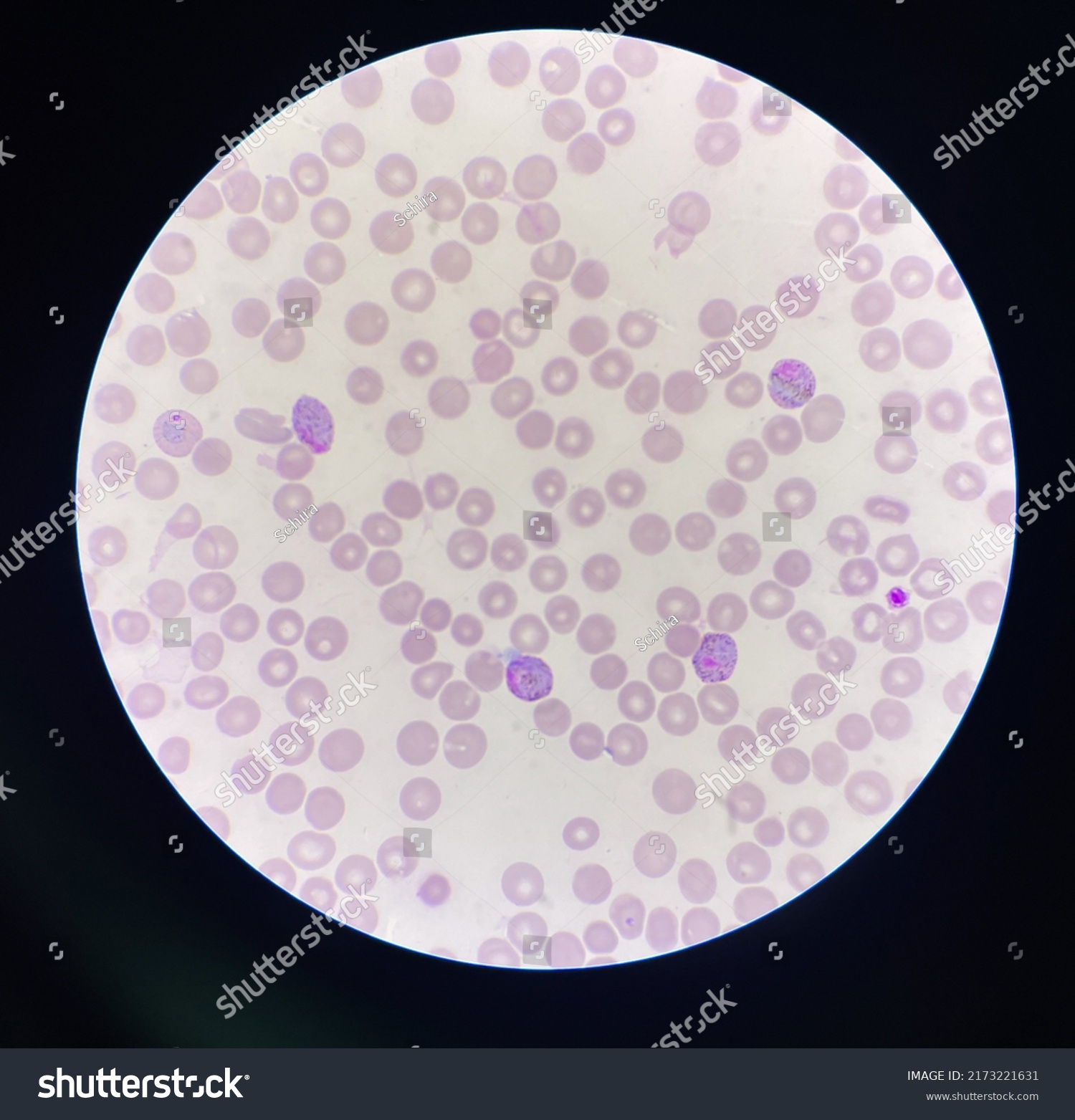 Malaria Blood Parasite Infected Red Blood Stock Photo 2173221631 ...