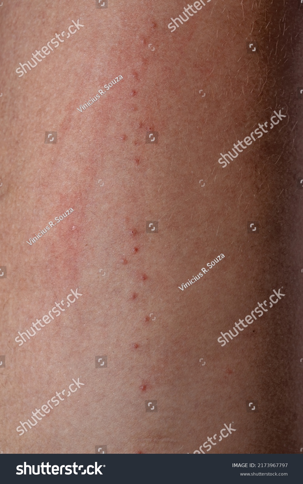 Human Skin Various Allergic Reactions Tick Stock Photo 2173967797