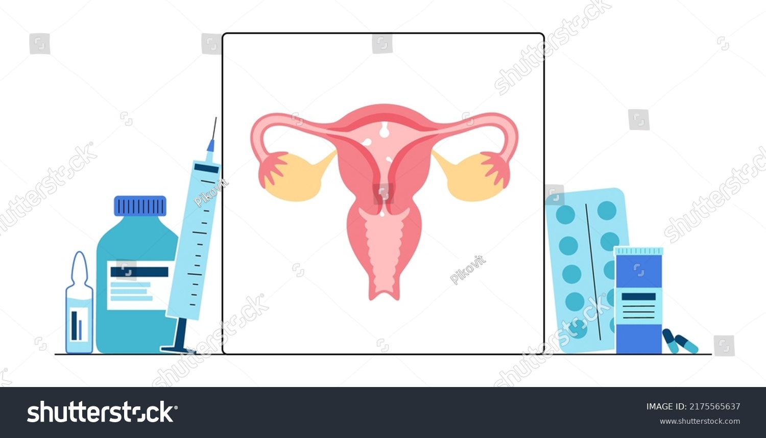 Uterine Polyps Anatomy Endometrial Disease Overgrowth Stock Vector