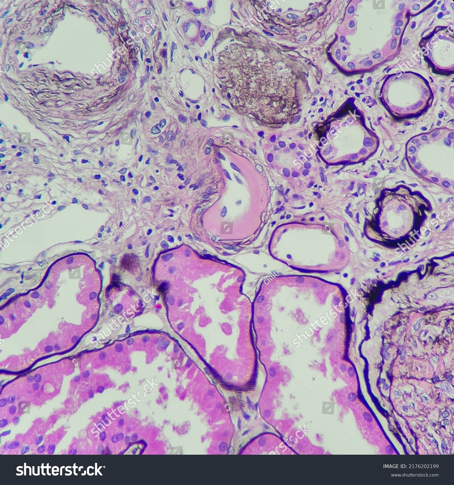 hyaline arteriolosclerosis