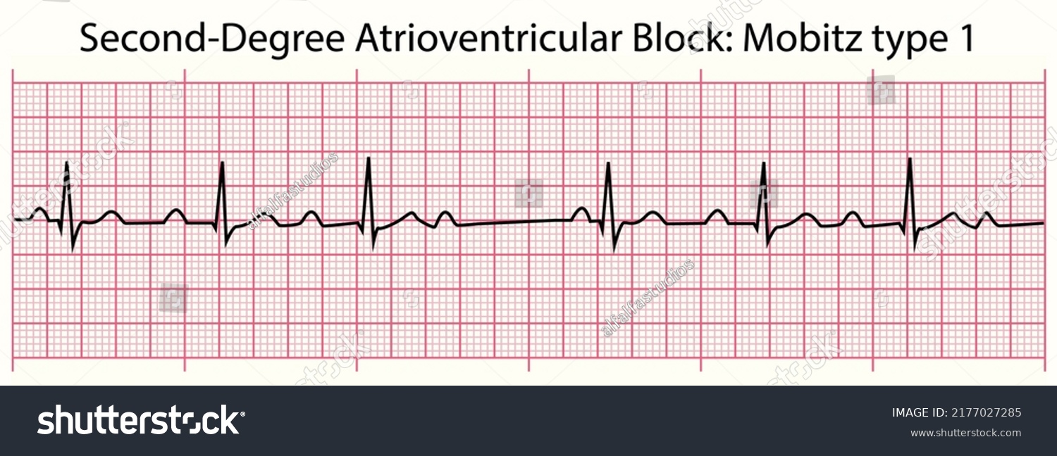 Ecg Line Seconddegree Atrioventricular Block Mobitz Stock Vector ...