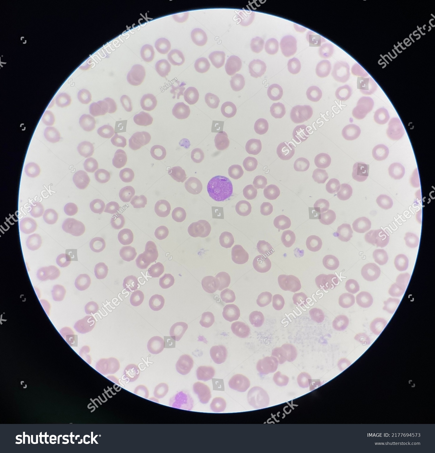 Immature White Blood Cell Leukaemia Stock Photo 2177694573 