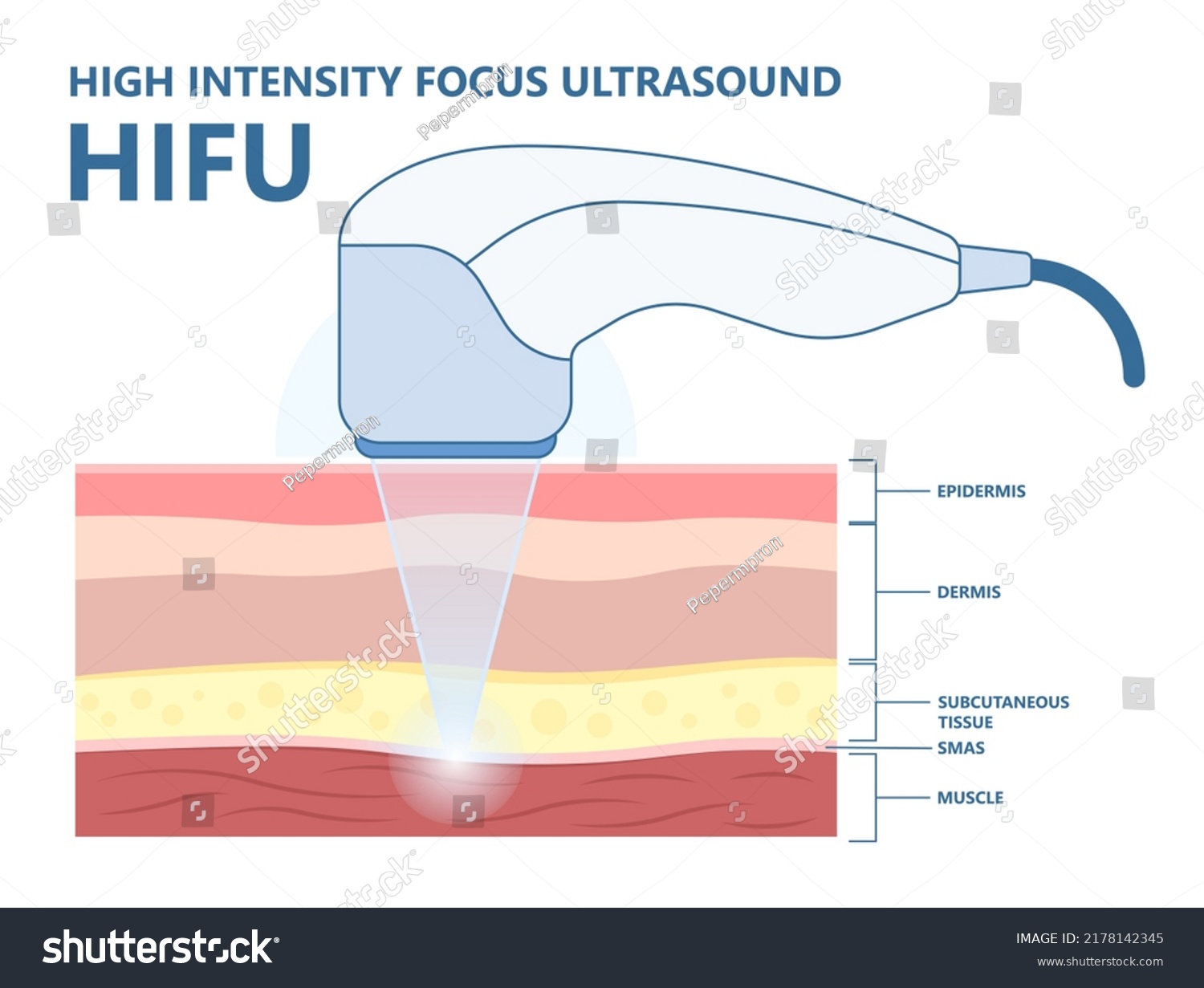 Hifu High Intensity Focus Ultrasound Face Stock Vector (Royalty Free ...