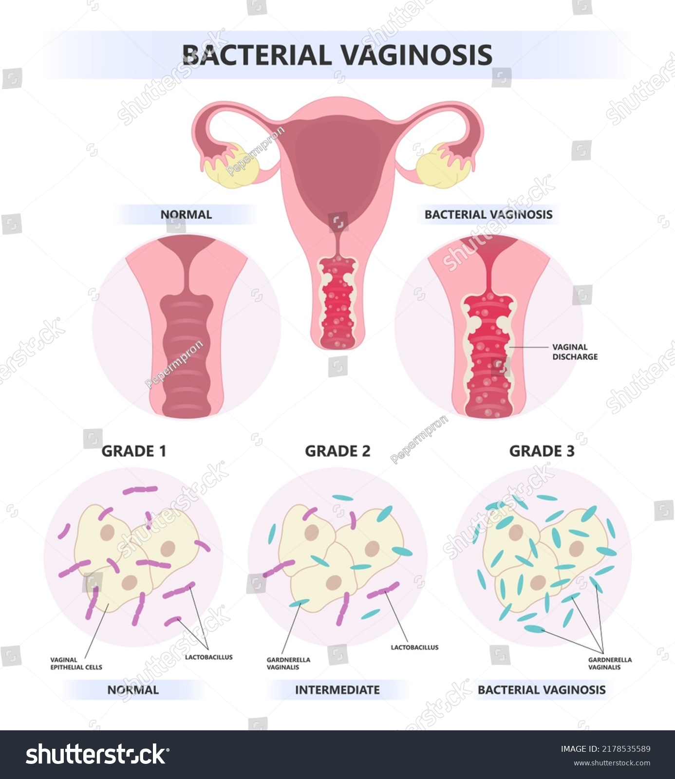 Sex With Bacterial Vaginosis