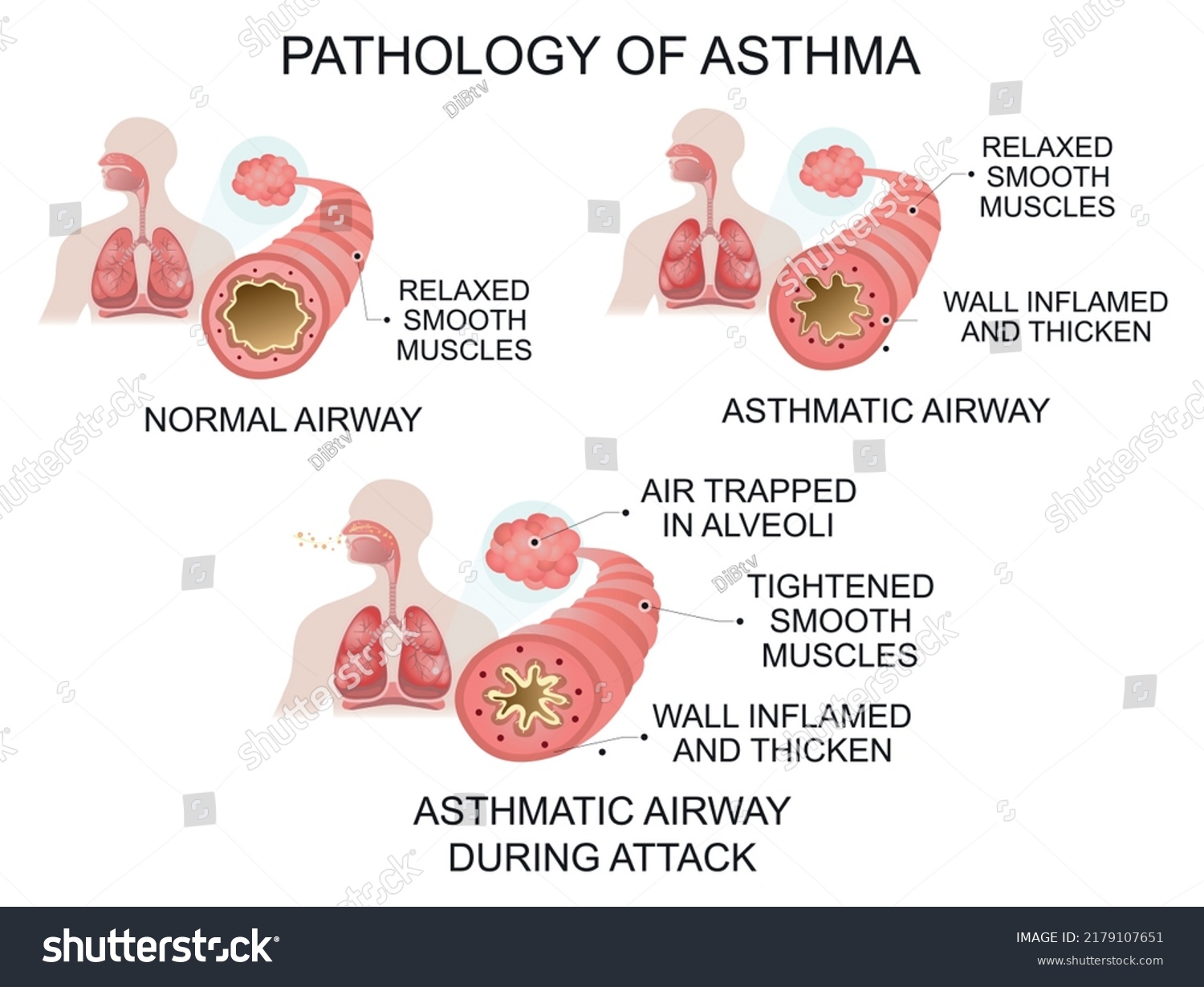 Pathology Asthma Medical Vector Illustration Stock Vector (Royalty Free ...