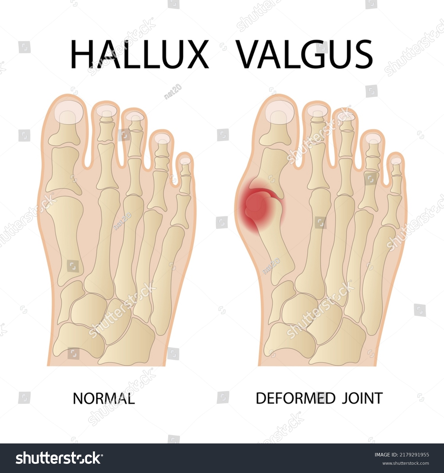 Hallux Valgus Medical Infographic Vector Illustration Stock Vector ...