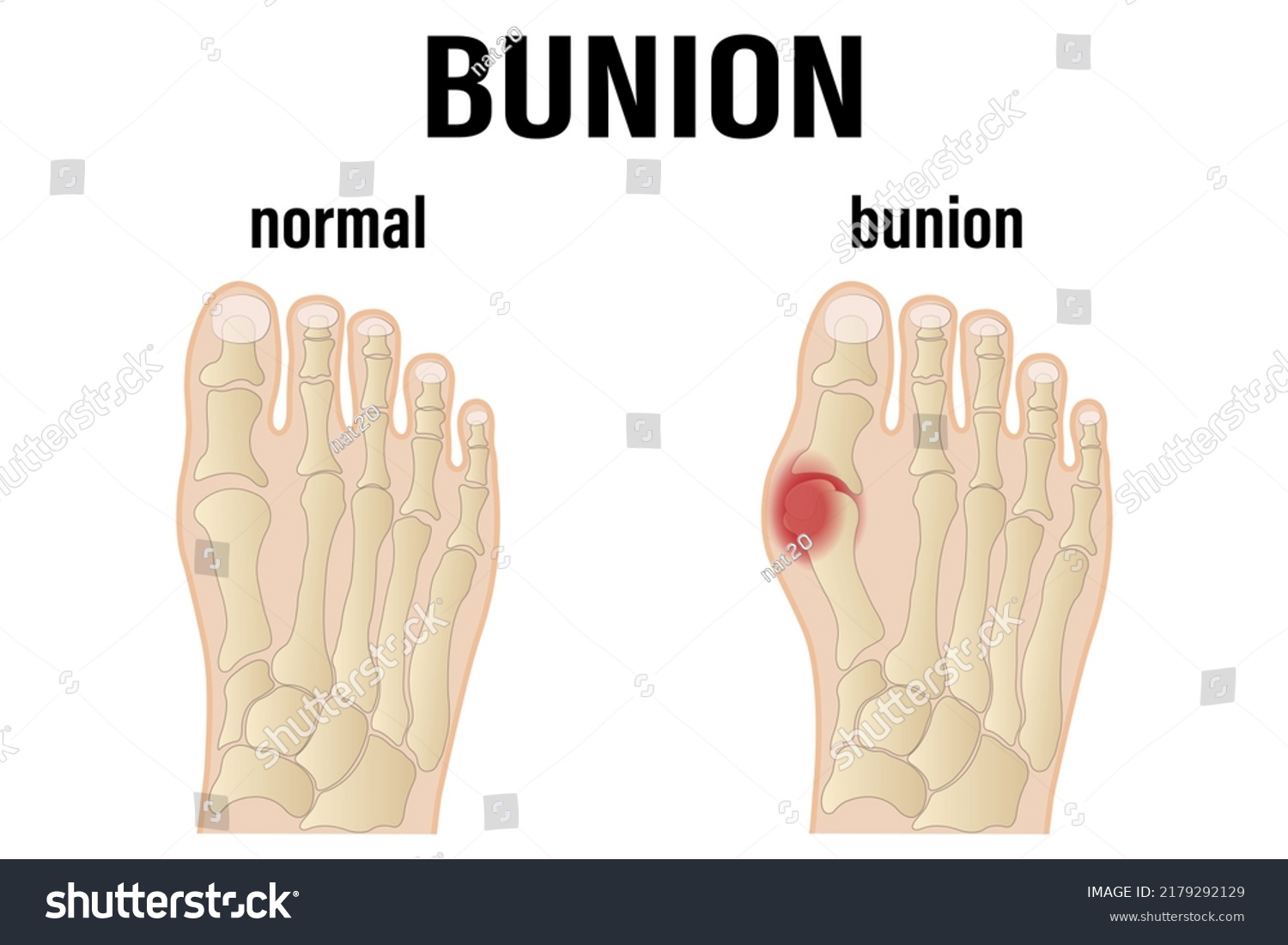 Hallux Valgus Medical Infographic Vector Illustration Stock Vector ...