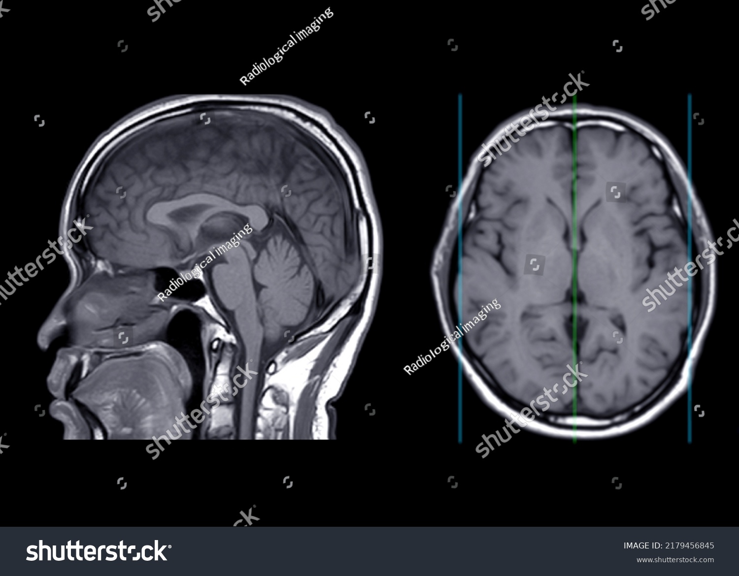 Mri Brain Axial T1w Plane Sagittal Stock Illustration 2179456845 