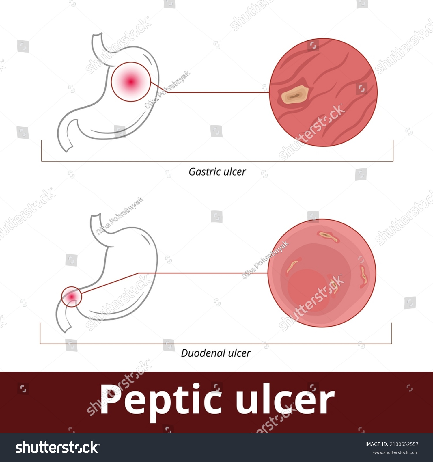 Peptic Ulcer Visualization Stomach Disease Including Stock Vector ...