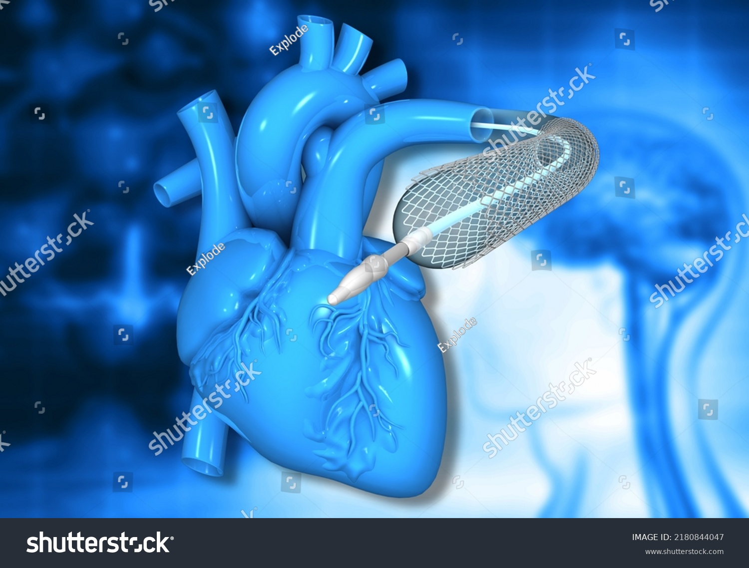 Balloon Angioplasty Surgery Heart 3d Illustration Stock Illustration