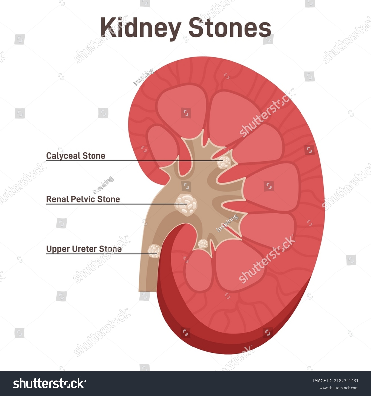 Nephrolithiasis Kidney Stones Disease Nephrology Urology Stock Vector ...