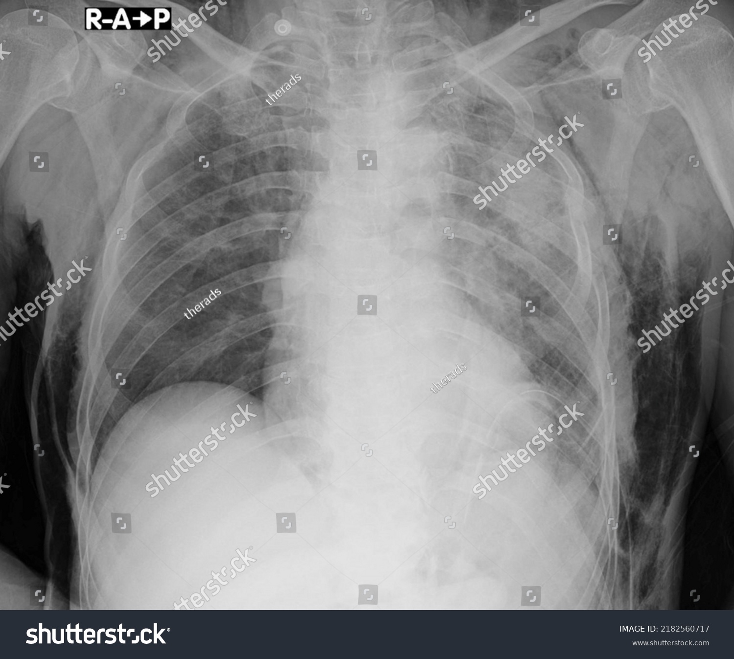 Ubcutaneous Emphysema Chest X Ray Subcutaneous Stock Photo 2182560717 ...