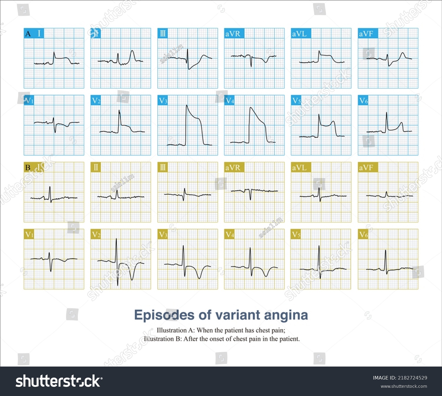 Female 64 Years Old History Hypertension Stock Illustration 2182724529 ...