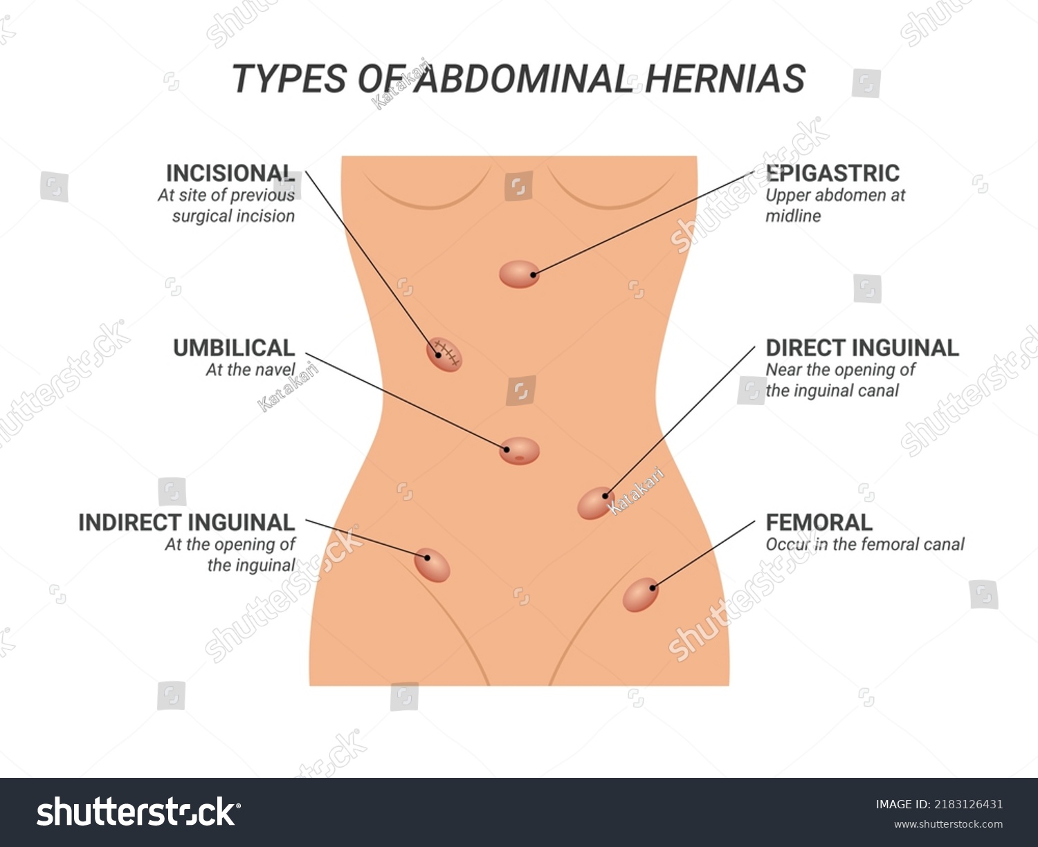 Types Abdominal Hernias Illustration On Isolated Stock Vector Royalty