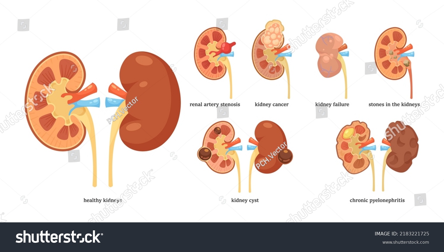 Healthy Kidneys Different Diseases Vector Illustrations Stock Vector ...