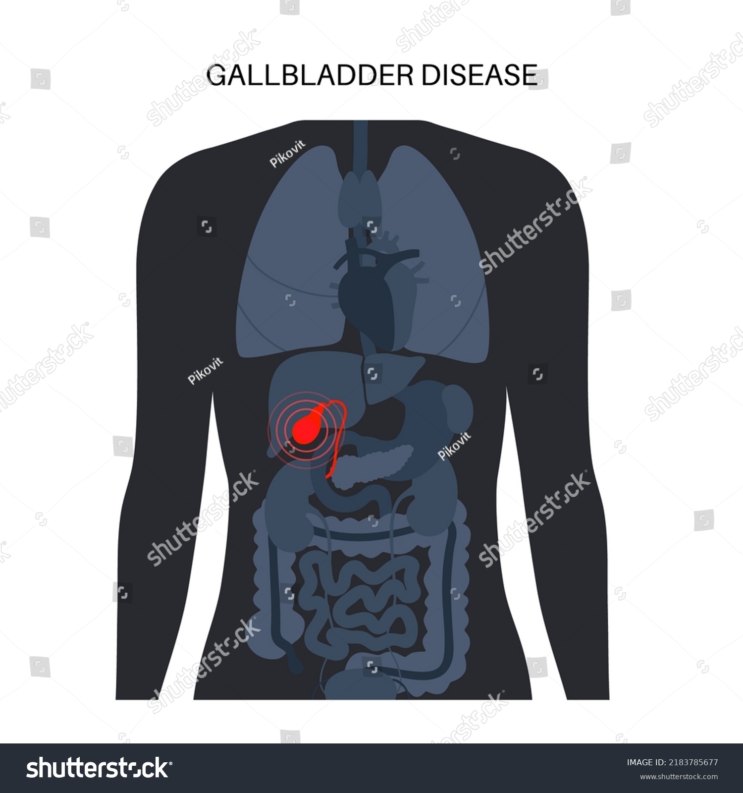 Gallbladder Diseases Infographic Gallstone Cancer Acute Stock Vector Royalty Free 2183785677