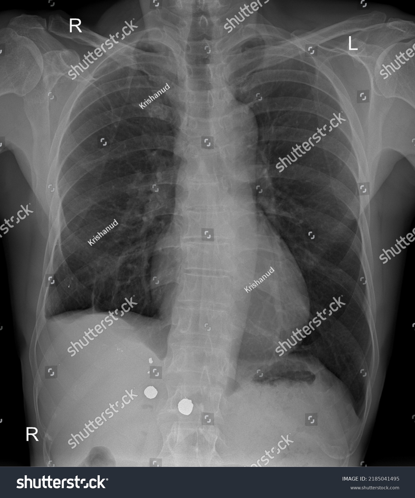 Chest Xray Showing Foreign Body Stock Photo 2185041495 | Shutterstock