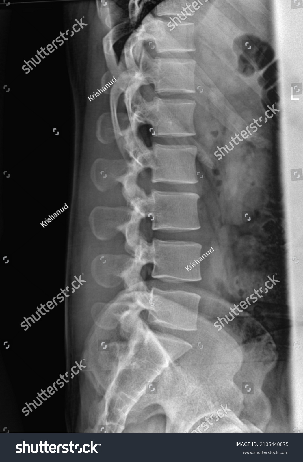 Lumber Spine Xray Lateral Radiograph Stock Photo 2185448875 | Shutterstock