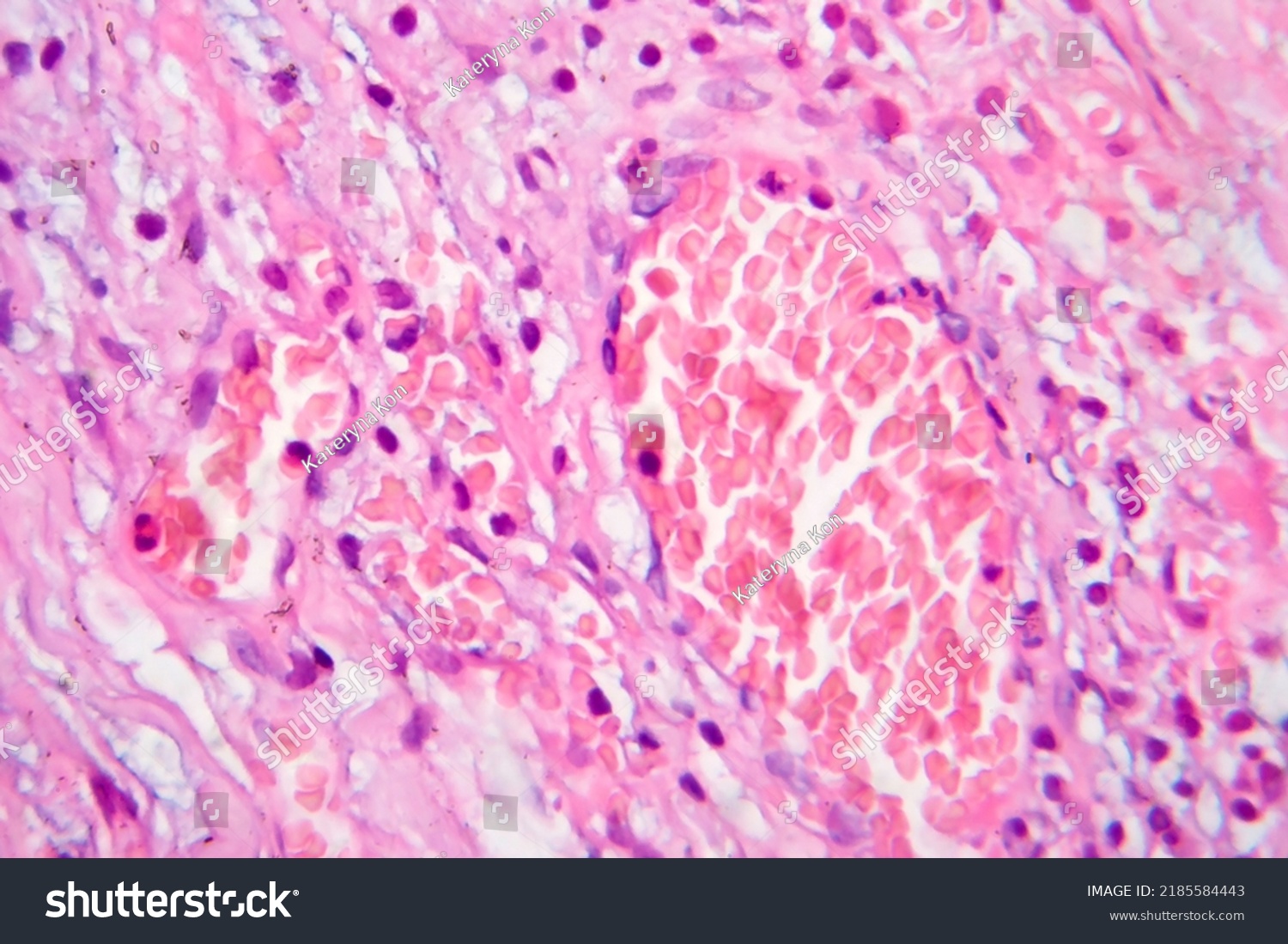 Fibrous Thyroiditis Light Micrograph Photo Under Stock Photo 2185584443 ...