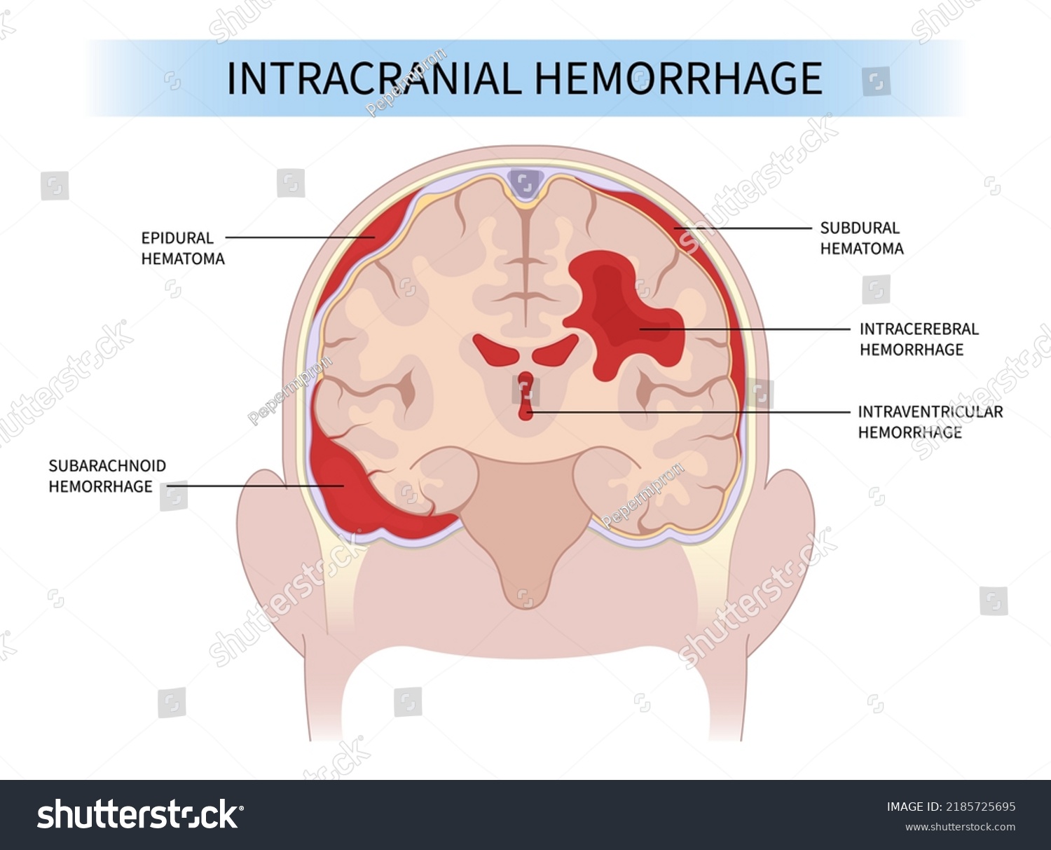 Brain Traumatic Injury High Blood Pressure Stock Vector (Royalty Free