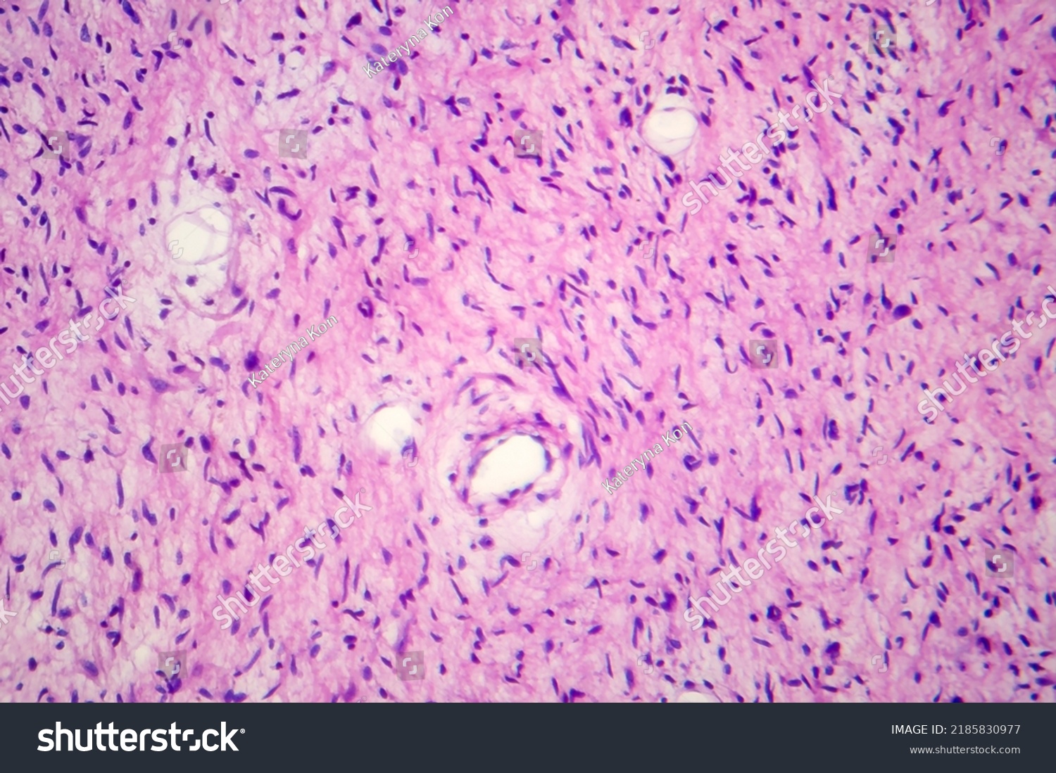 Neurofibromatosis Light Micrograph Photo Under Microscope Stock Photo 