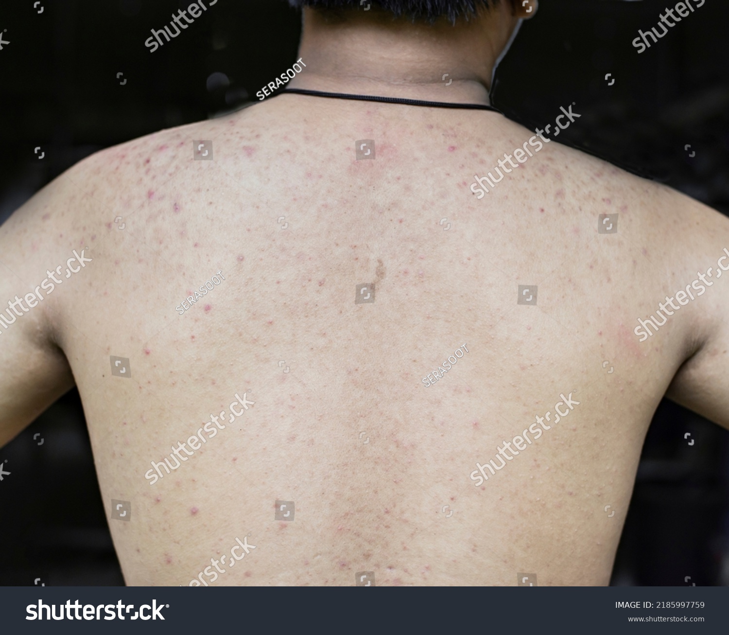 Dermatitis Rash Red Bump On Skin Foto Stok 2185997759 | Shutterstock