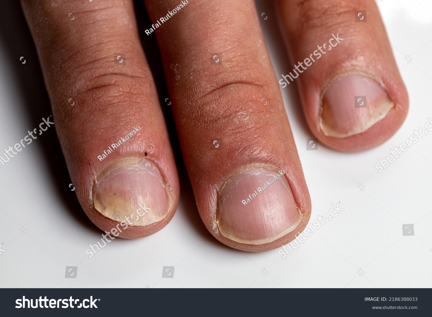 hand-fingers-psoriatic-onychodystrophy-psoriatic-nails-2186388033