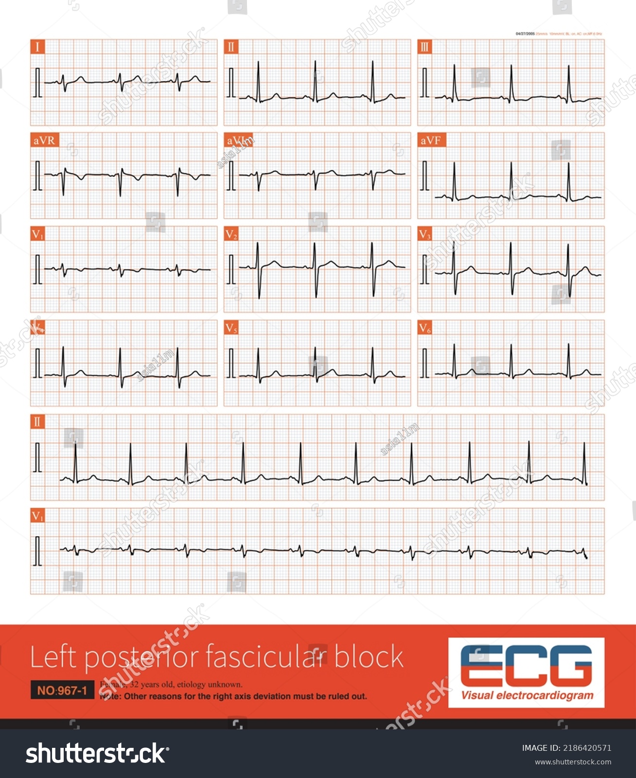 During Left Posterior Fascicular Block Ecg Stock Illustration ...