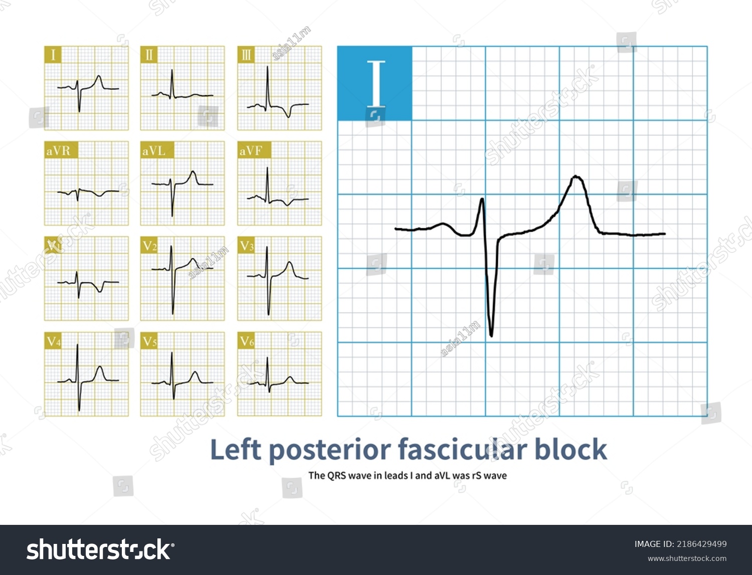 During Left Posterior Fascicular Block Ecg Stock Illustration ...