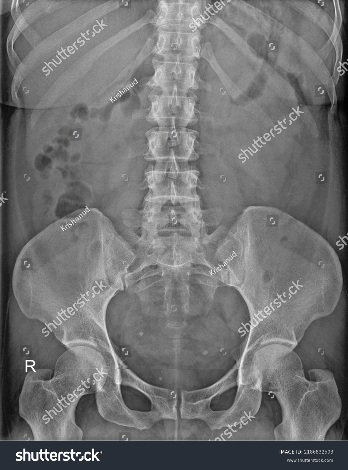 Xray Kub Showing Urinary Bladder Calculus Stock Photo 2186832593