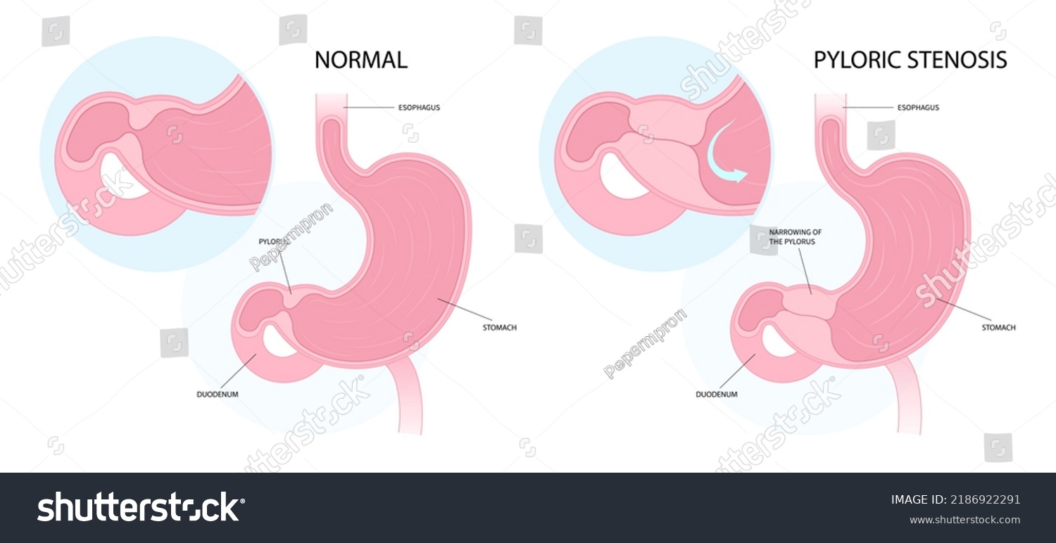 Pyloric Stenosis Newborn Enlarged Pylorus Stock Vector (Royalty Free ...