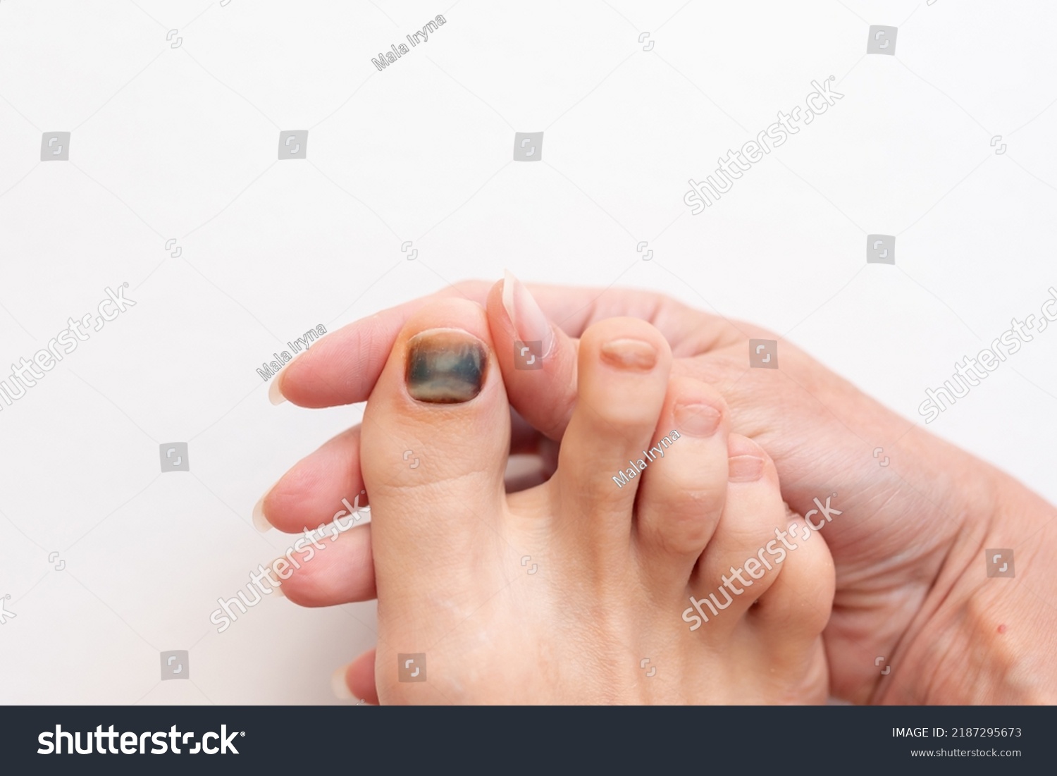 Subungual Hematoma Present Under Toenail Hallux Stock Photo 2187295673 ...