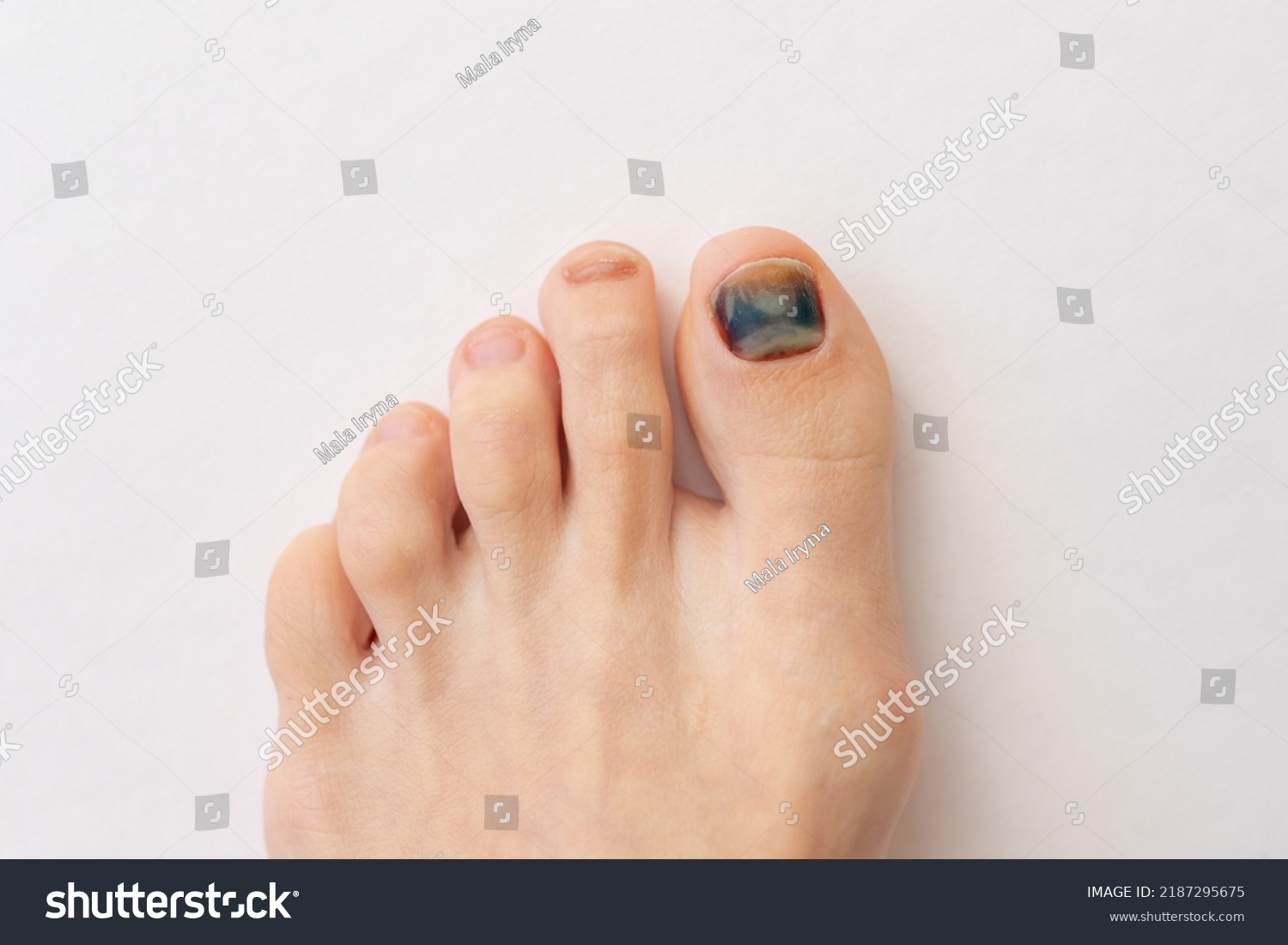 subungual hematoma left great toenail icd 10