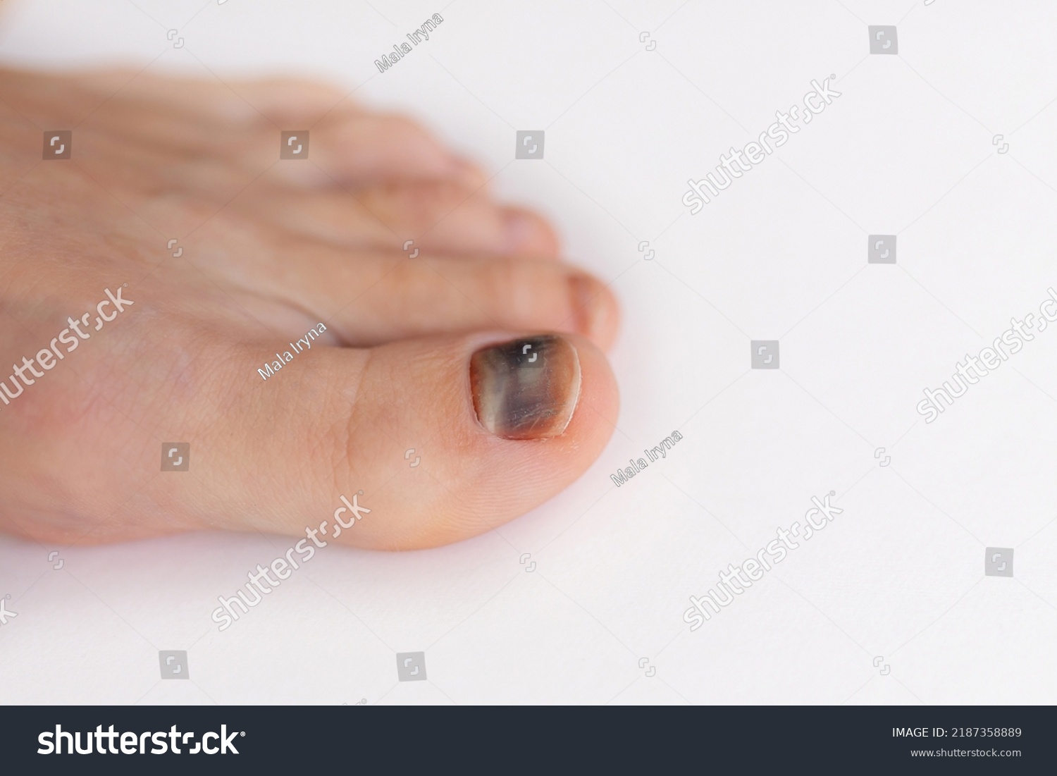 subungual-hematoma-present-under-toenail-hallux-stock-photo-2187358889