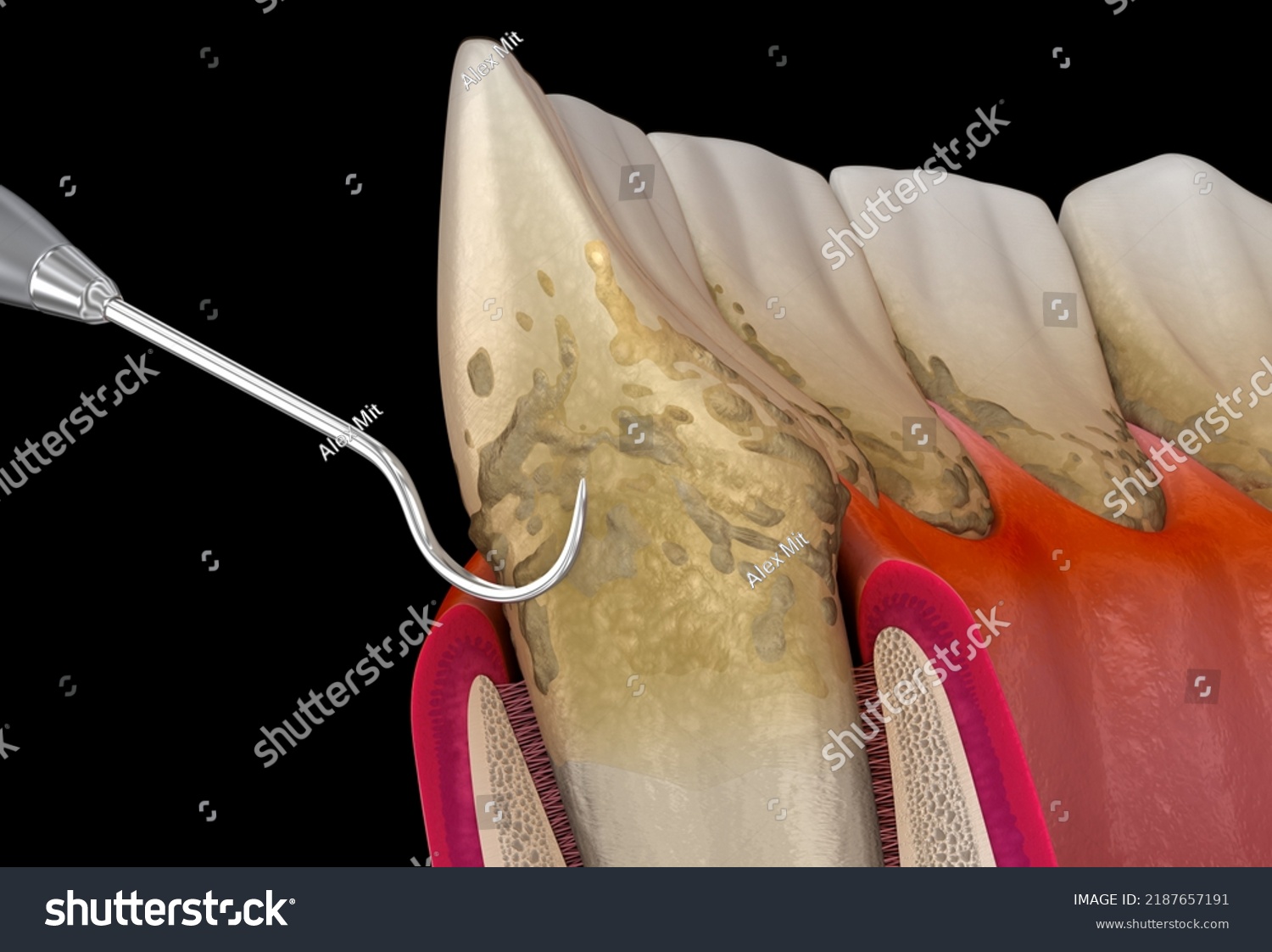 Oral Hygiene Scaling Root Planing Conventional Stock Illustration 2187657191 Shutterstock 0718