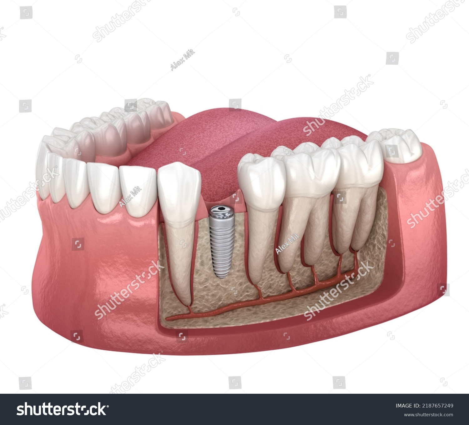 Cover Screw Dental Implant Medically Accurate Stock Illustration   Stock Photo Cover Screw And Dental Implant Medically Accurate D Illustration 2187657249 