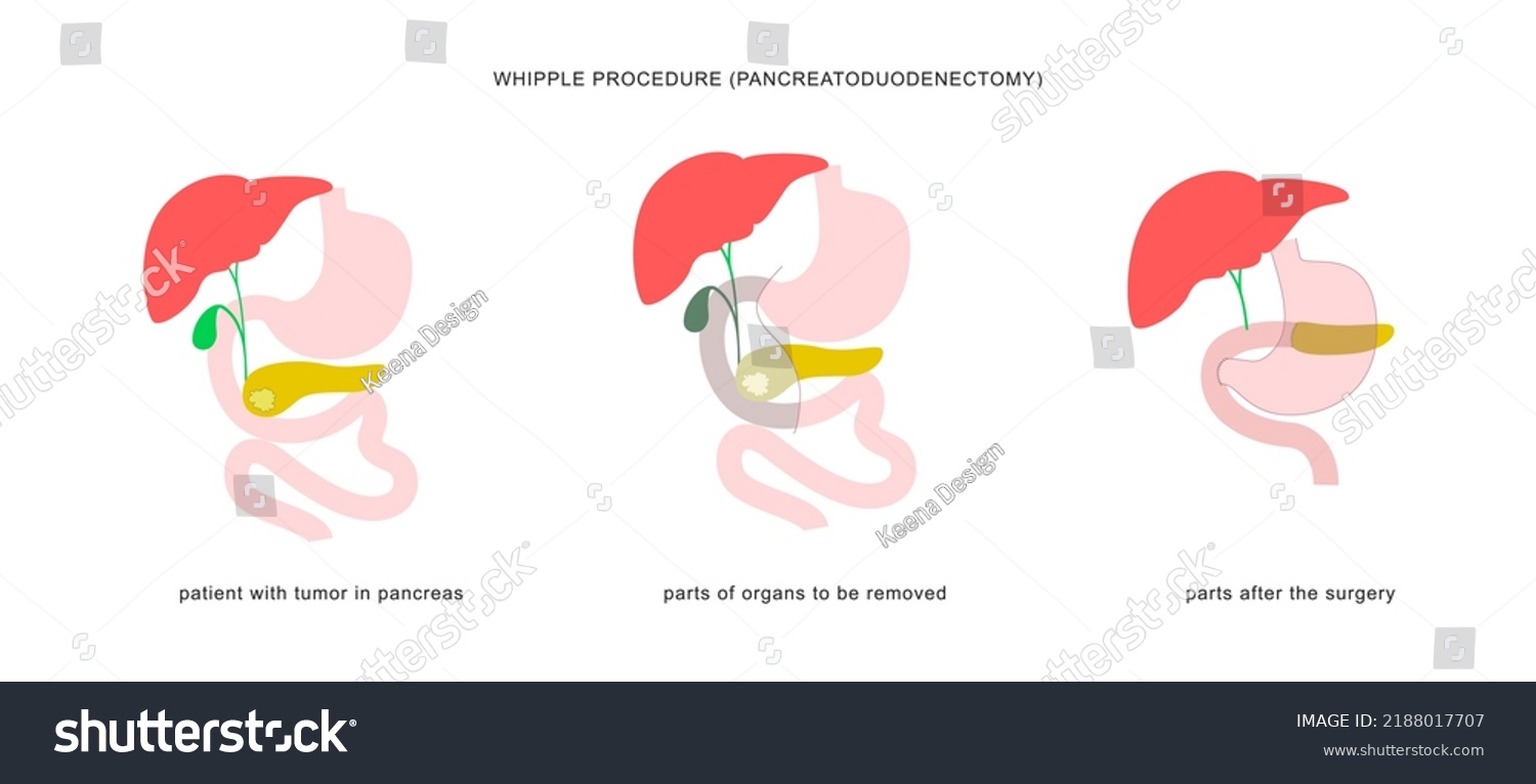 Medical Infographic Whipple Procedure Pancreaticoduodenectomy Surgery