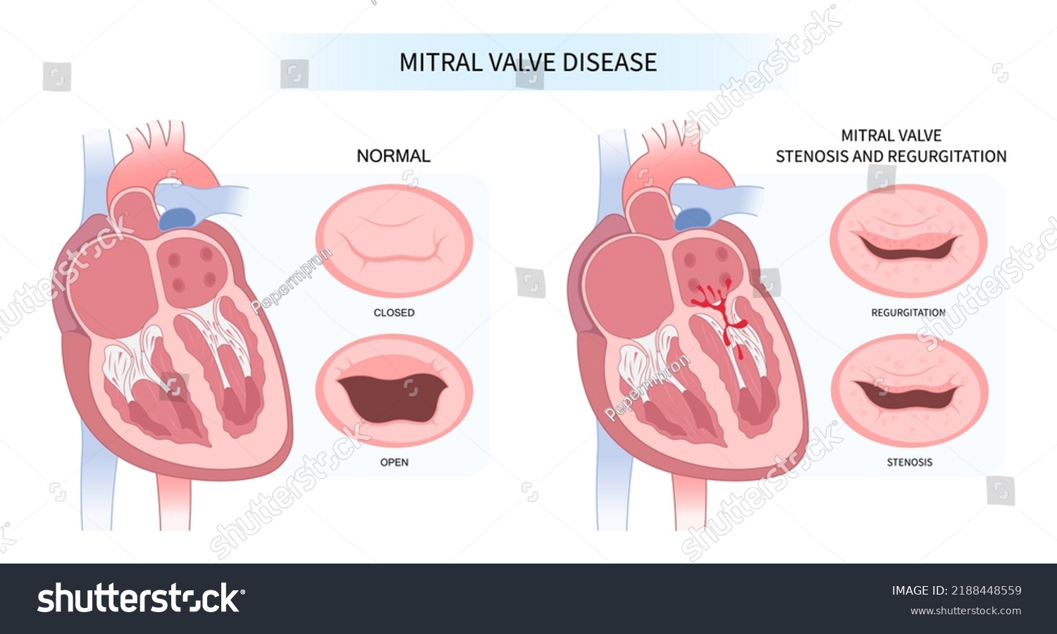 cardiac-heart-murmur-disease-cath-lab-stock-vector-royalty-free