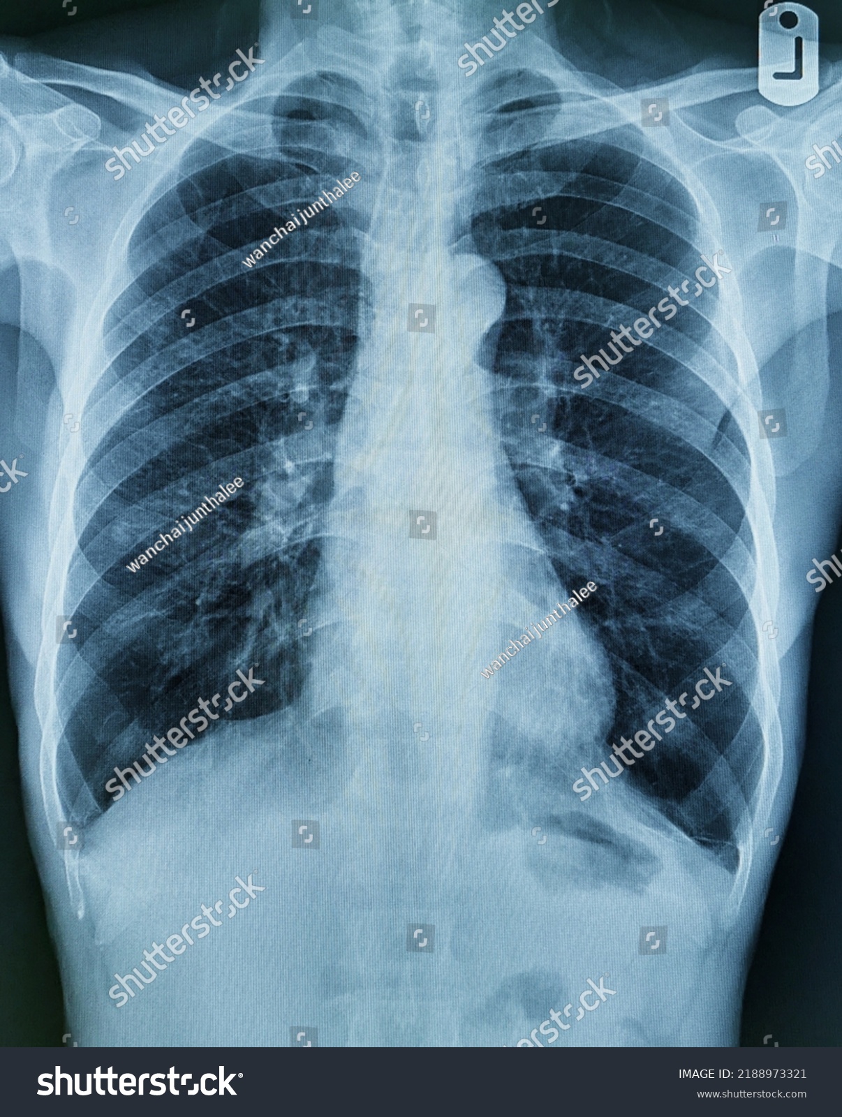 Xray Images Chest Abdomen Stock Photo 2188973321 | Shutterstock