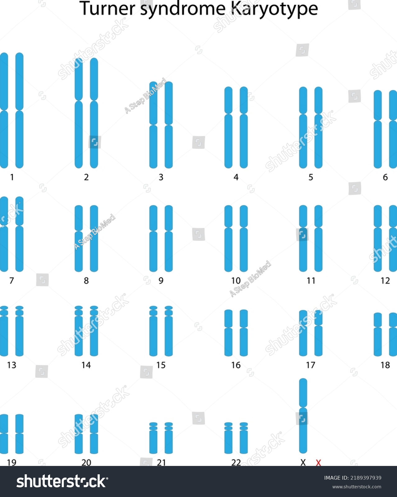 Turner Syndrome X0 Human Karyotype Stock Vector Royalty Free 2189397939 Shutterstock 4923