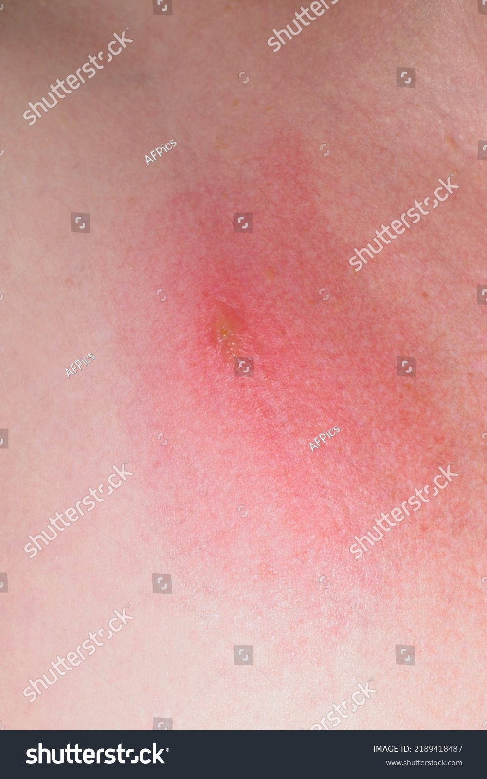 inflamed-insect-bite-upright-format-stock-photo-2189418487-shutterstock