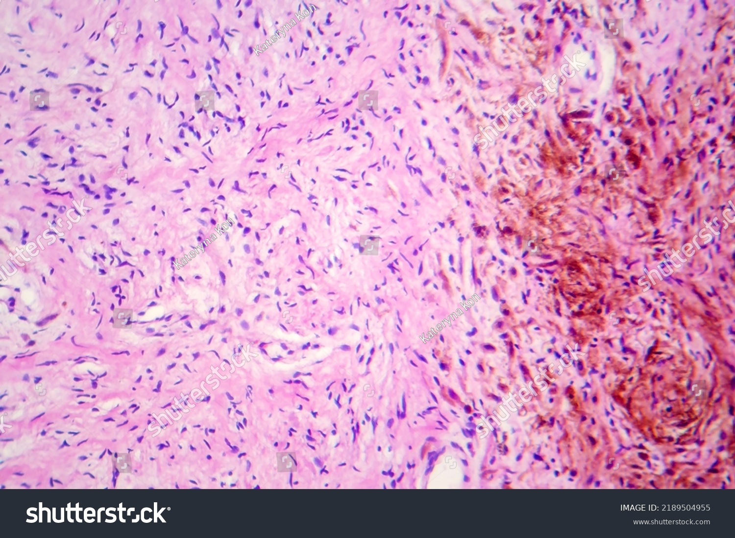 Neurofibromatosis Light Micrograph Photo Under Microscope Stock Photo ...